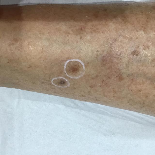 look before Cryotherapy treatment