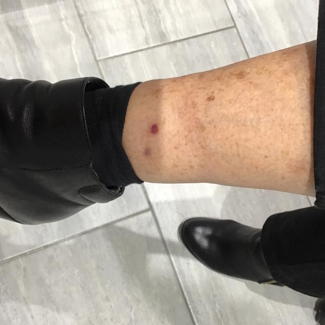 after Cryotherapy treatment