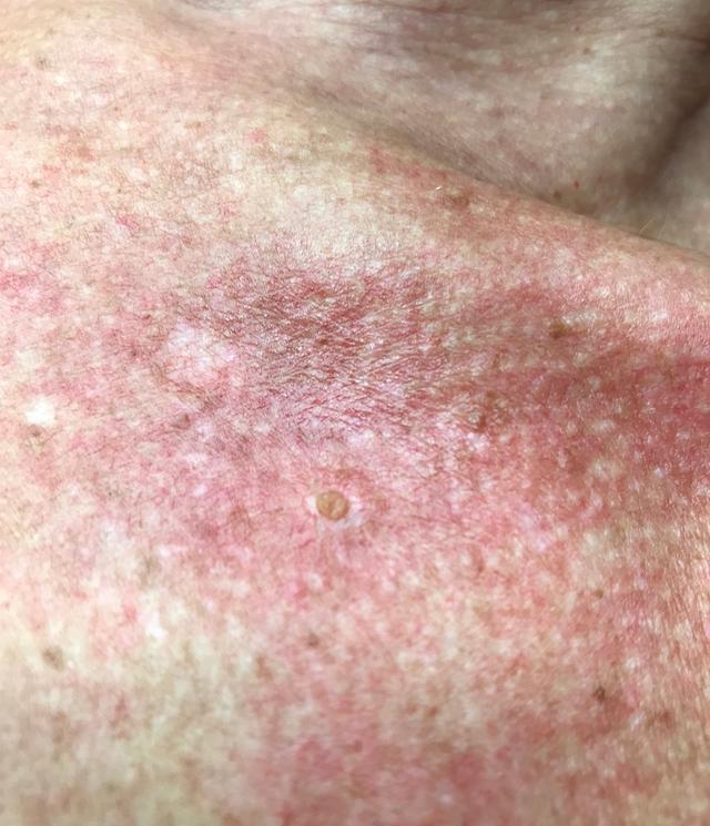 look after Skin Tag Removal treatment