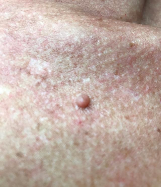 look before Skin Tag Removal treatment