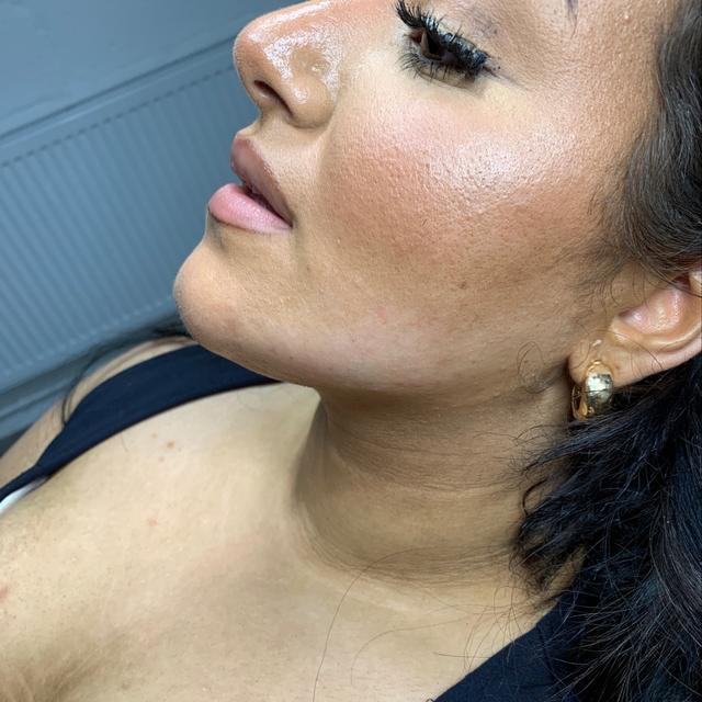 look after Chin Filler treatment