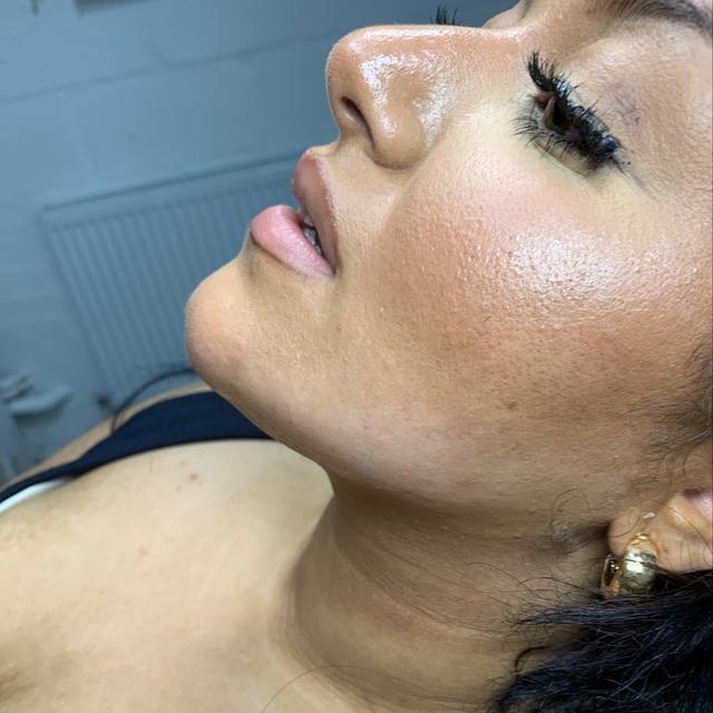 after Chin Filler