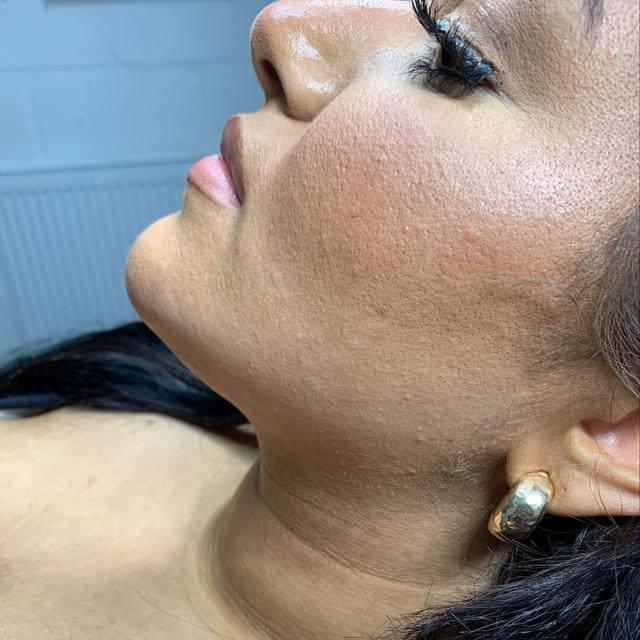 look before Chin Filler treatment