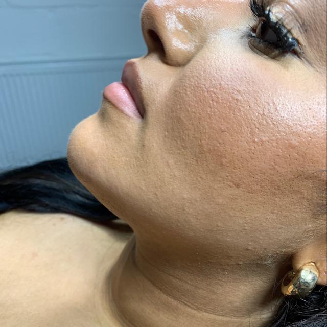 before Chin Filler