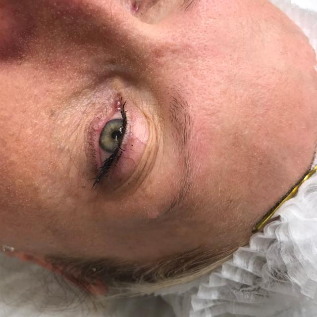 before Microblading treatment