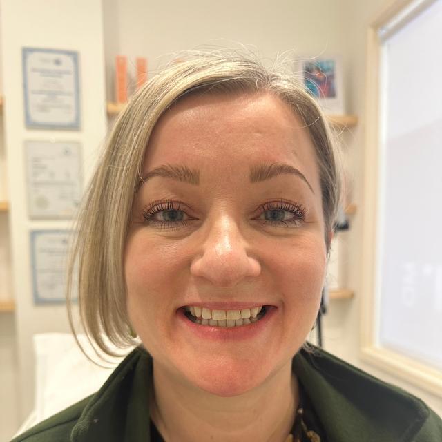 before Lip Flip treatment