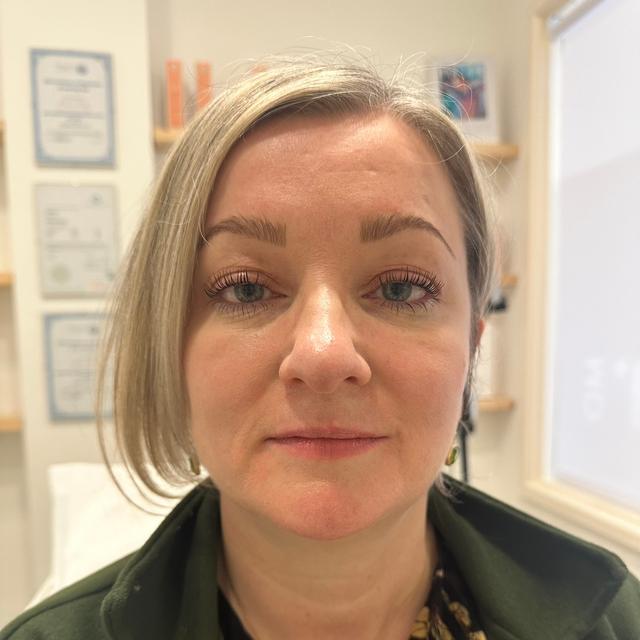 look before Lip Flip treatment