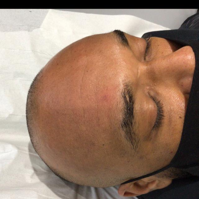 after Cryotherapy