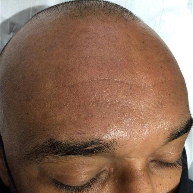 before Cryotherapy