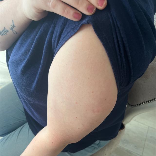 after Kenalog Injection