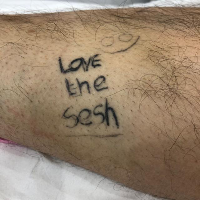 before Laser Tattoo Removal treatment