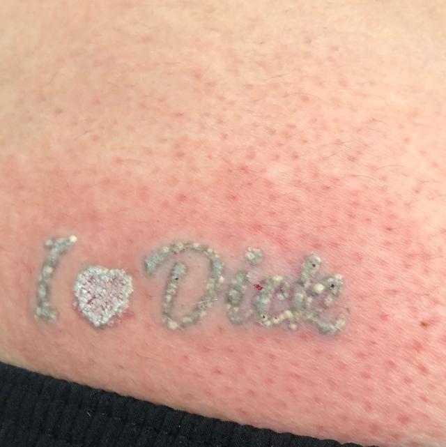 look after Laser Tattoo Removal treatment