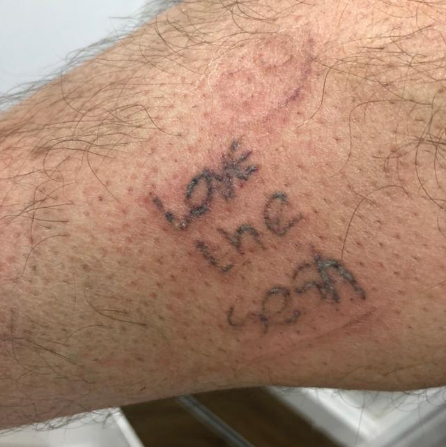 after Laser Tattoo Removal treatment
