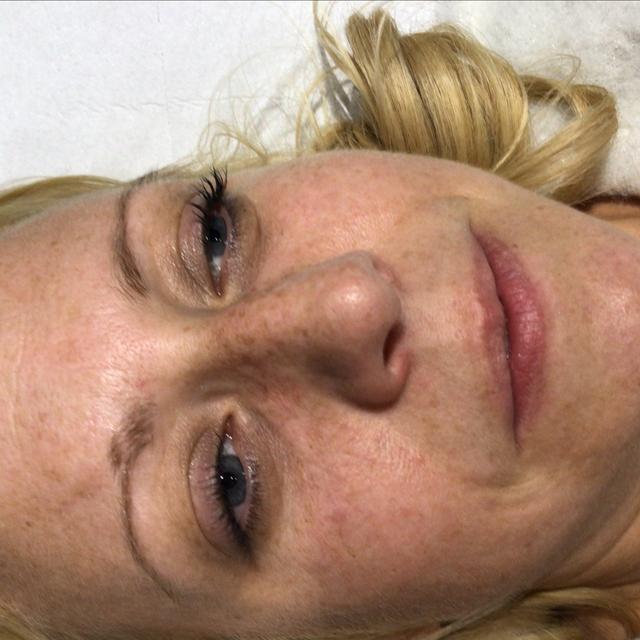 look after Thread Vein Removal treatment