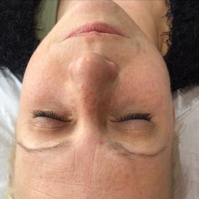 look before Thread Vein Removal treatment