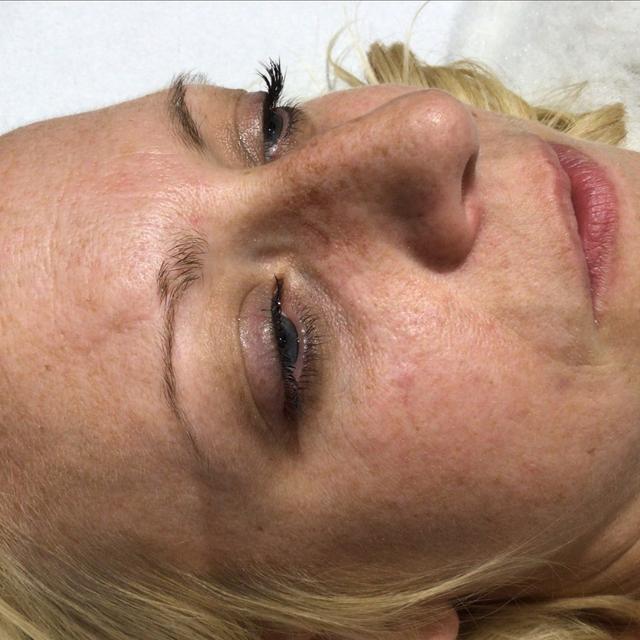 after Thread Vein Removal