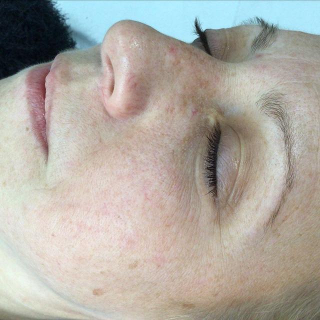 before Thread Vein Removal