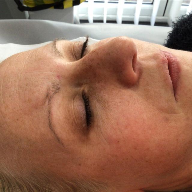 before Thread Vein Removal treatment