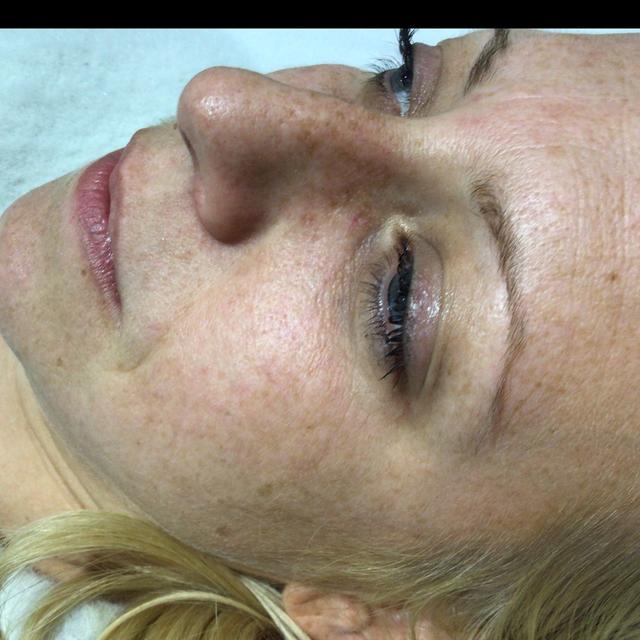 after Thread Vein Removal treatment