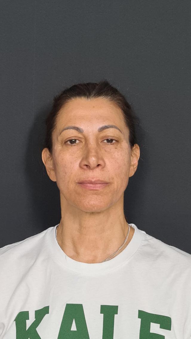 after Face Lift treatment