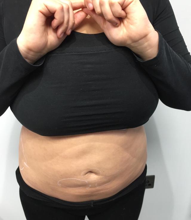 look before Aqualyx treatment