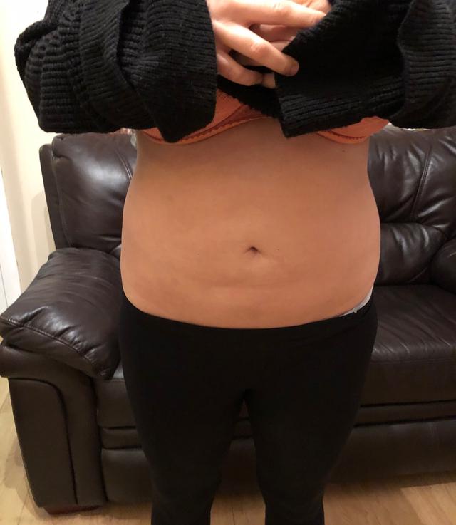 look after Aqualyx treatment