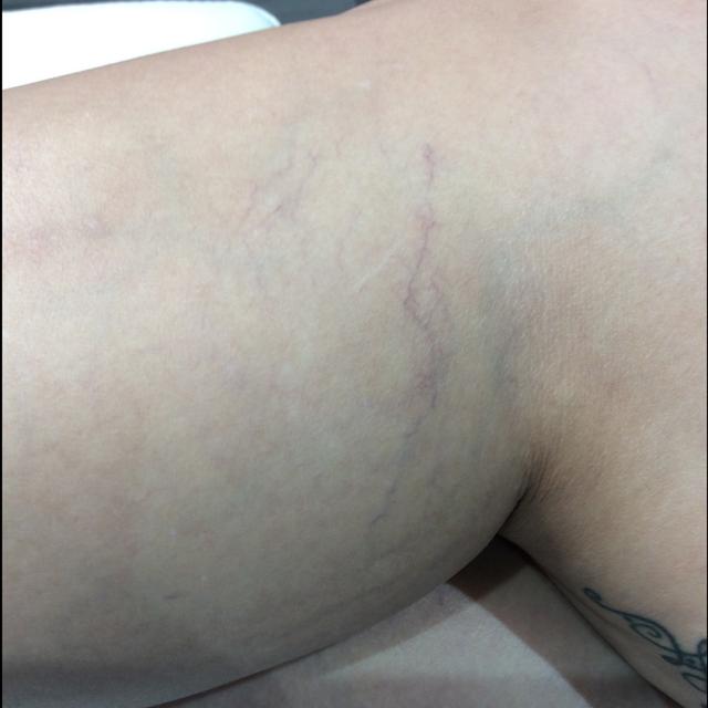 before Electrolysis treatment