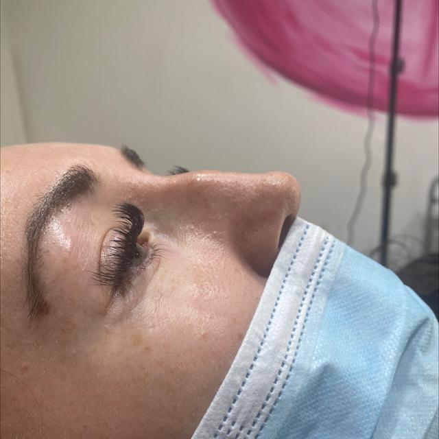 before Nose Filler treatment