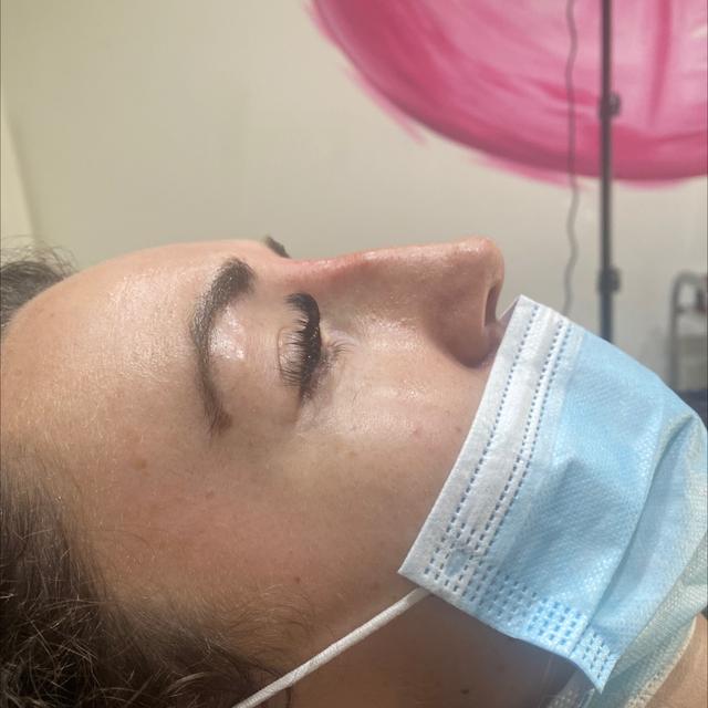 after Nose Filler treatment