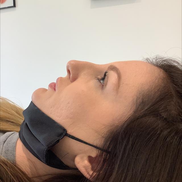 before Nose Filler
