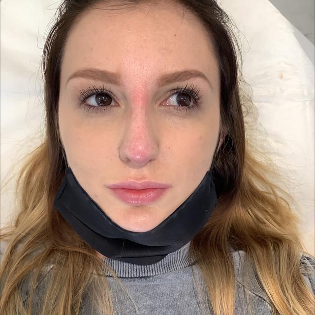 look after Nose Filler treatment