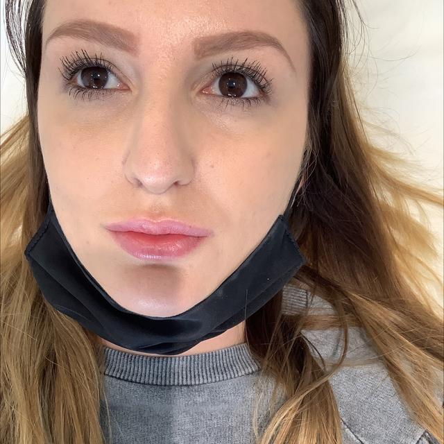look before Nose Filler treatment