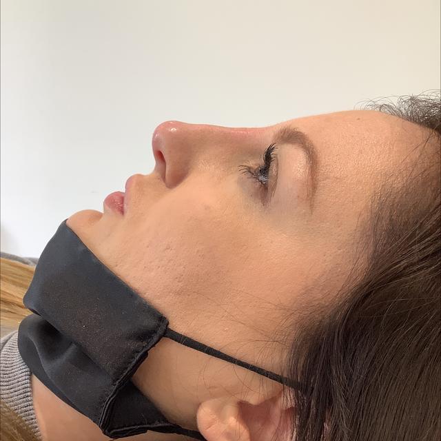 after Nose Filler