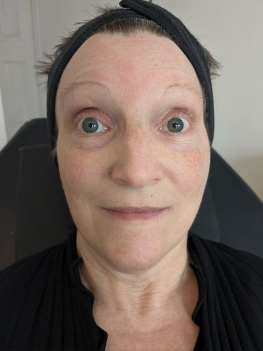 before Microneedling