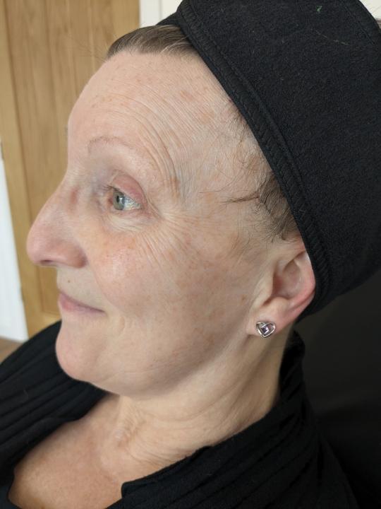 before Microneedling treatment