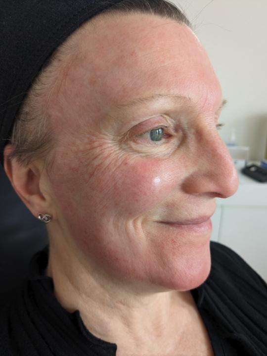 look after Microneedling treatment