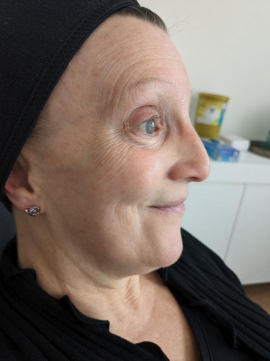 look before Microneedling treatment
