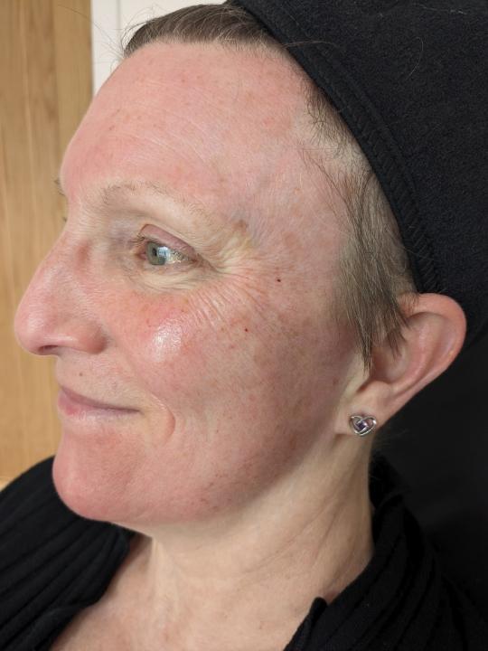 after Microneedling treatment