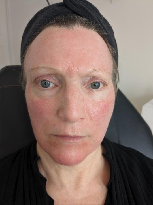 after Microneedling
