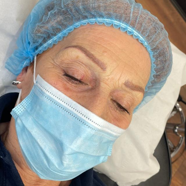 look before Micro Pigmentation treatment