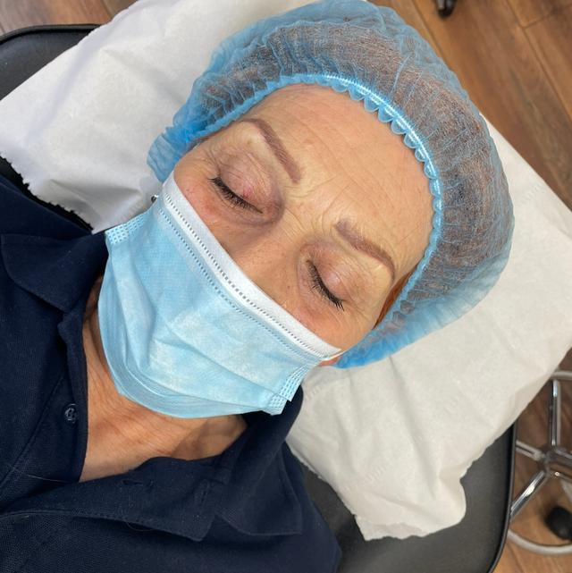 before Micro Pigmentation treatment