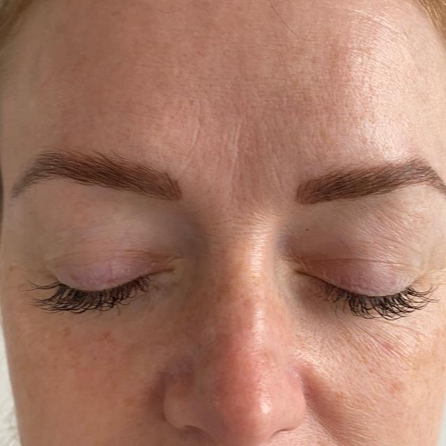 after Lemon Bottle treatment