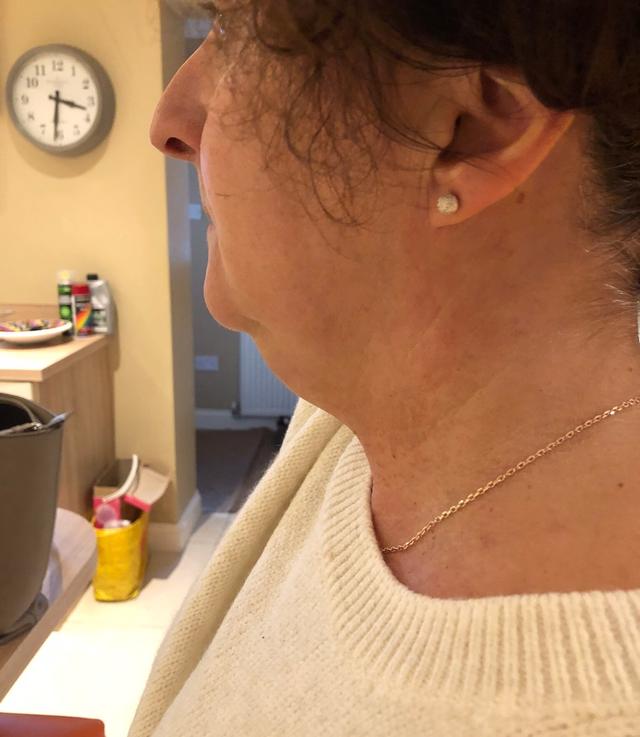 after Aqualyx treatment