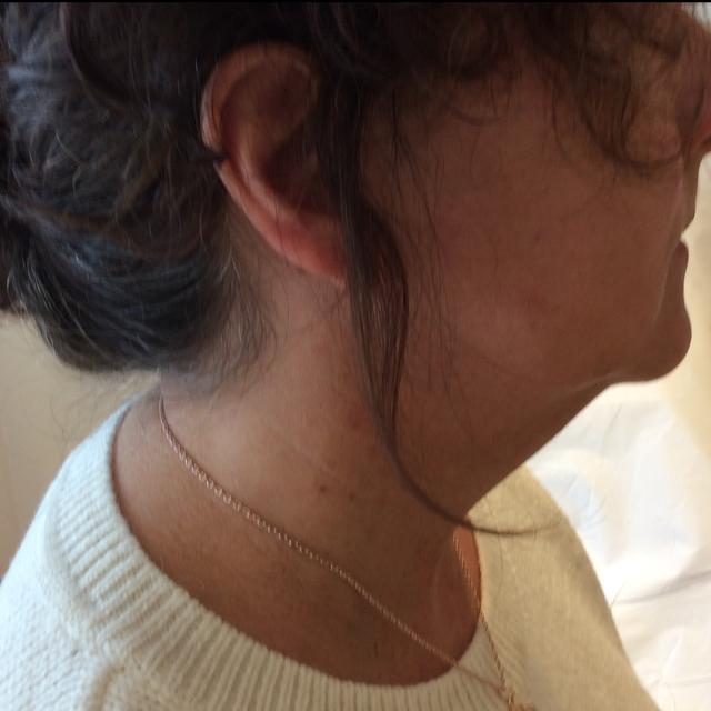 before Aqualyx treatment