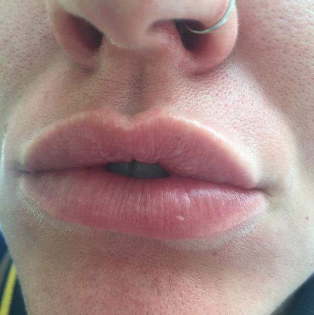before Lemon Bottle