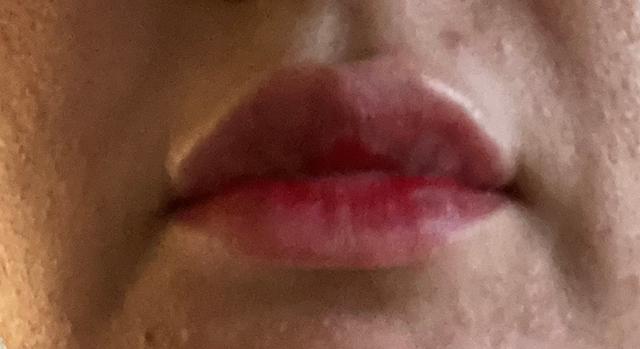 after PRP treatment