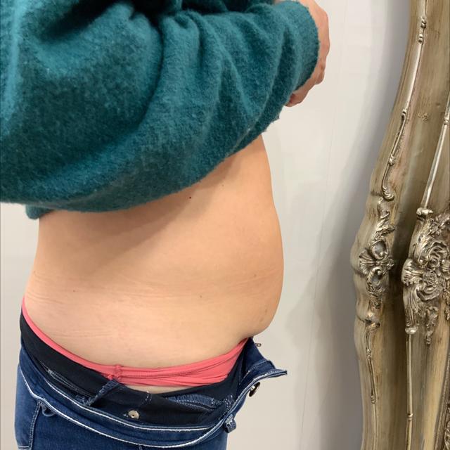 look after Cryolipolysis treatment
