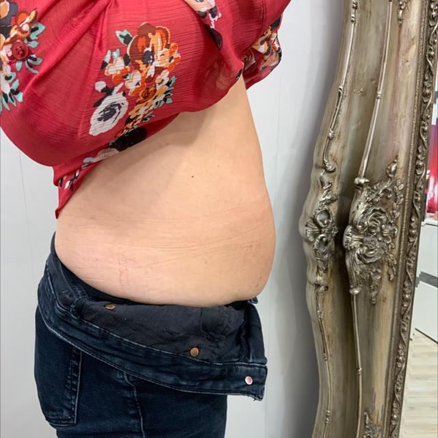 look before Cryolipolysis treatment