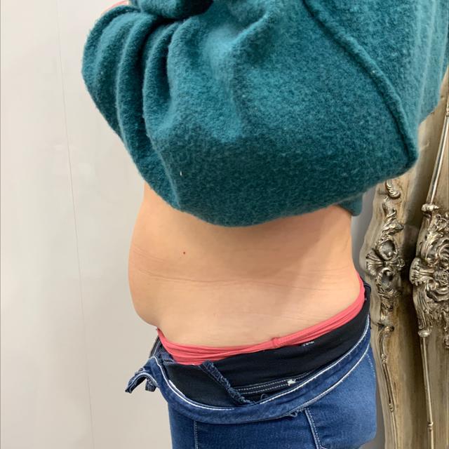 after Cryolipolysis