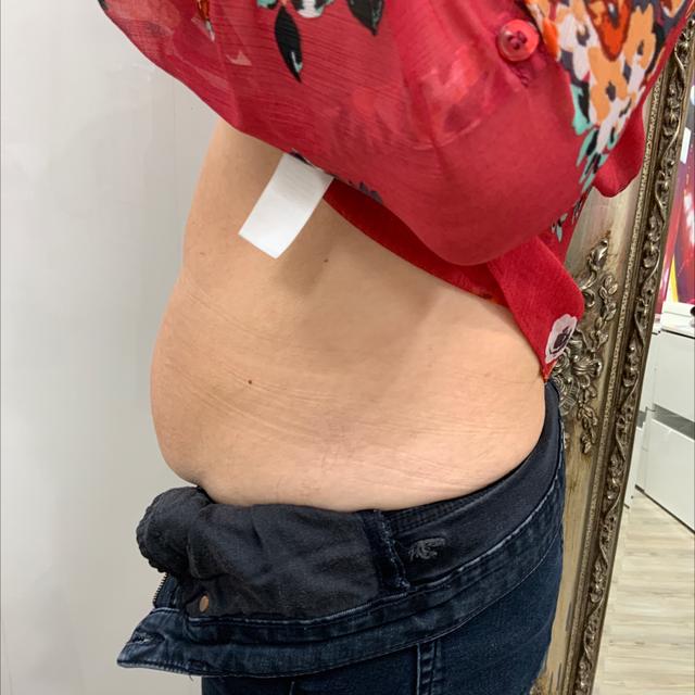 before Cryolipolysis